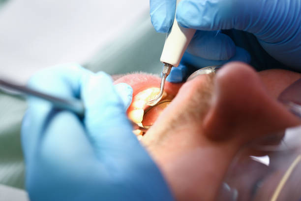 Best Emergency Tooth Extraction in Cedar Hills, OR